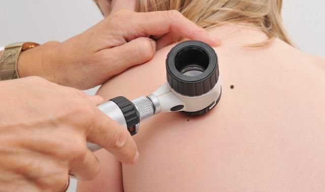 身上的痣,该如何去掉?3个方法,各有所长