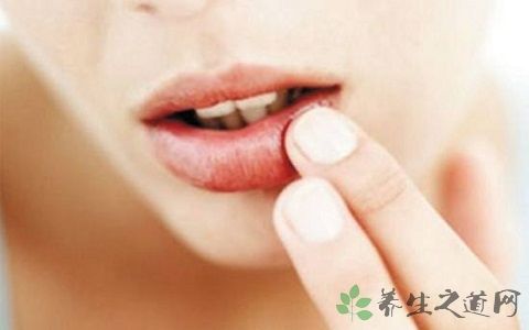 口角生疮吃什么药