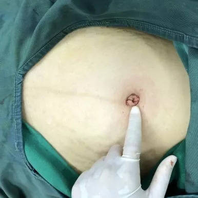 医线‖我院产二科妇科组成功开展经脐单孔腹腔镜手术