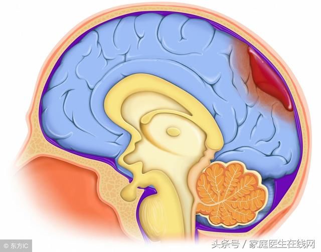 脑梗发病前的6个征兆，有一个都要赶紧去医院！