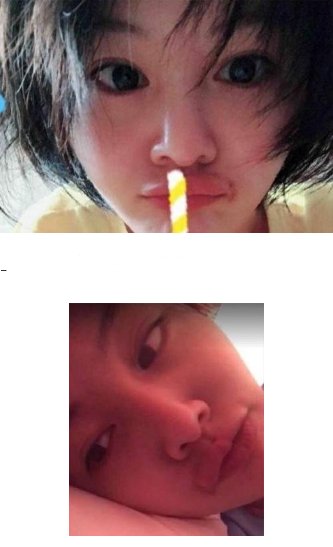 郑爽嘴巴受伤黑一圈疑长胡子 网传整容所致各