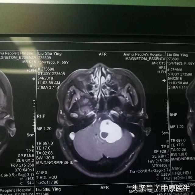 追求极致：本来只需要安全手术，这个医生却选择最难的