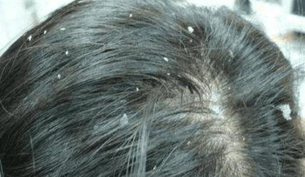 头上抓下油腻白粘物原来是它的粪便,2招清干