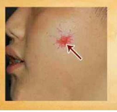 有蜘蛛痣=有肝硬化?看了这个你就懂了