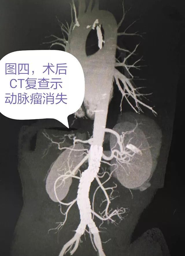 航空总医院普外科与导管室成功为一例巨大腹主动脉瘤患者行腔内治