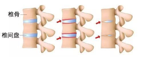 颈腰椎衰老分5个阶段，你现在到了哪一步?