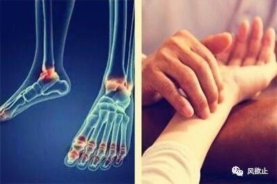 痛风毋需非布!中医内外结合,1个月尿酸就降到