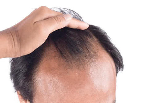 老是掉头发什么原因,溢脂性脱发怎么治疗?