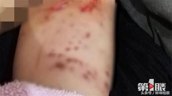 重庆4龄童被拴于人行道的比特犬咬住不松口，众人救下送医