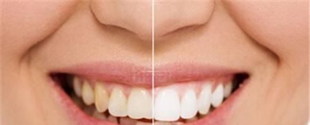 门牙缝发黑蛀牙的图片