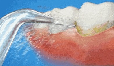 用了漱口水,还需刷牙吗