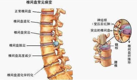 的常见3大常见表现(腰椎间盘突出、椎管狭窄、