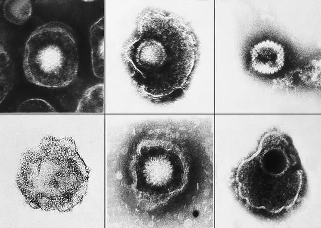 水痘痊愈就能终生免疫？其实病毒仍潜伏在神经