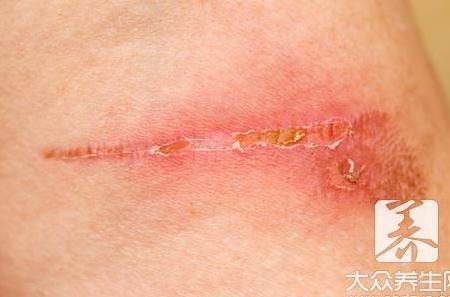 刮伤了口子怎么处理?
