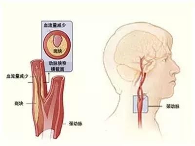 高血压伴颈动脉狭窄患者，血压降到多少合适？