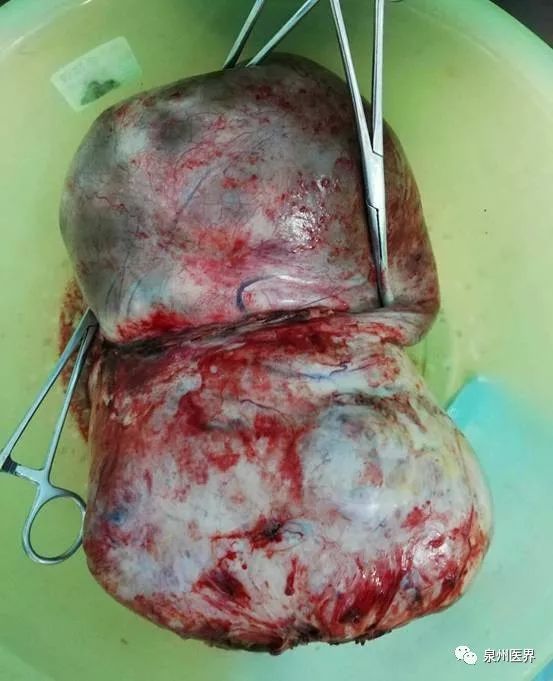 德化县中医院妇产科成功切除罕见巨大卵巢肿瘤