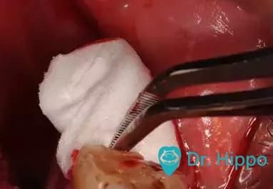 拔牙后半小时再度出血怎么办