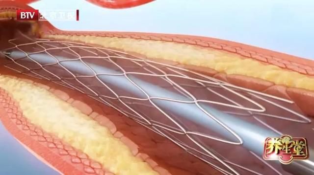 装了支架就万无一失了吗？警惕低血压的发生，防止心梗再度来袭！