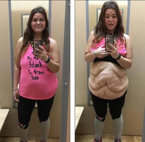 胖妞减肥190斤,肚子上留下20斤重的赘皮,如同