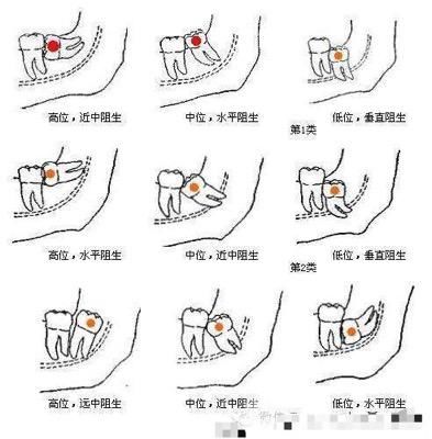 15天内拔4颗智齿的经验分享贴