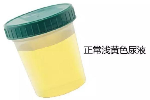 尿尿黄、泡沫多、异味重?一泡尿反映全身健康