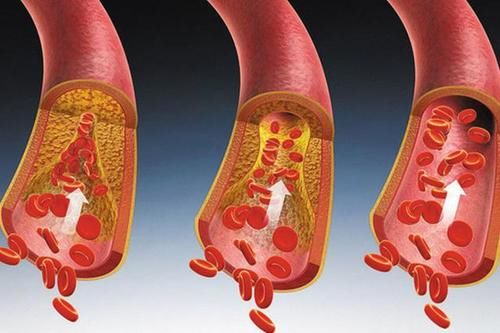 你的血液健康吗?堵塞了怎么办?只要一招教你