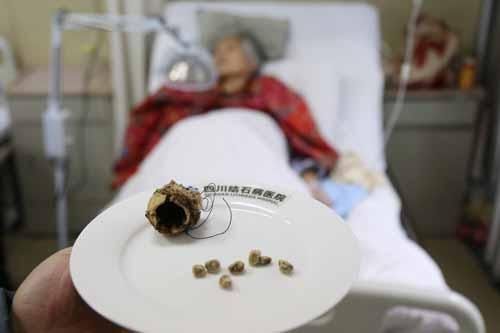 四川结石病医院为一位85岁老人取出陶瓷胆囊