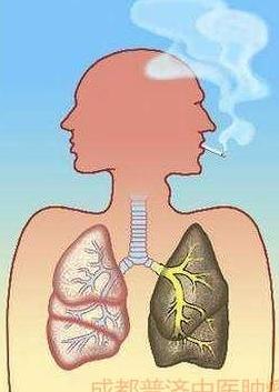 为什么肺肿瘤确诊的时候已经到了中晚期?