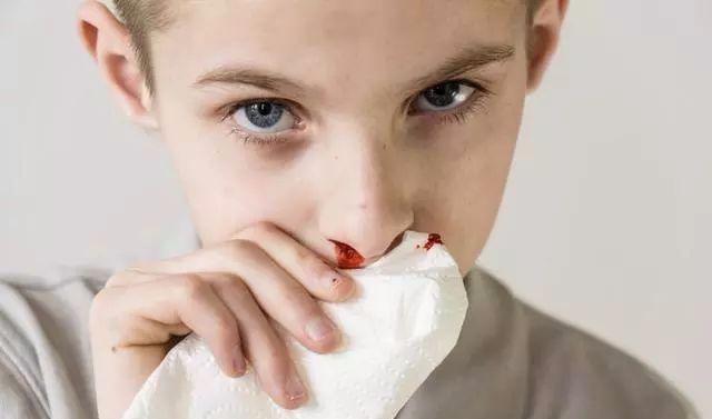 经常流鼻血别大意 可能是这一病症的早期