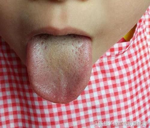 注意!当舌苔出现这8种状况说明你的身体健康存