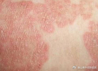 急性湿疹早期的症状有哪些表现