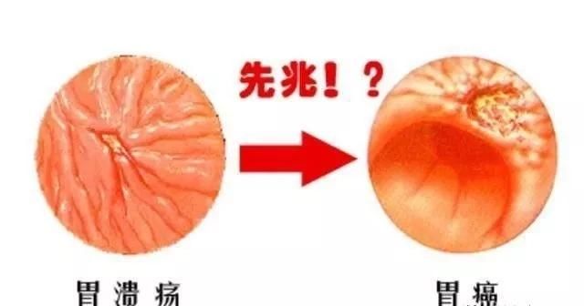 消化科医生提醒:这3个信号是胃癌,不是胃炎!早发现可保命