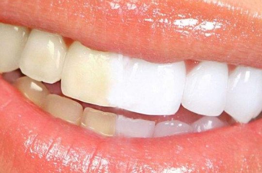 牙齿种植的费用