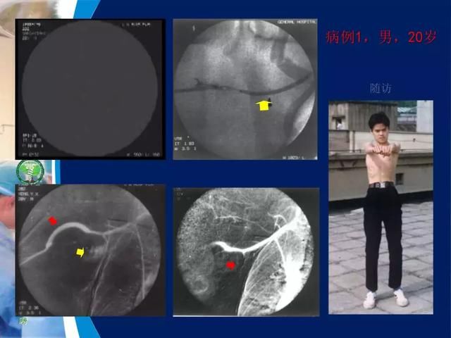 39年前开创“复合手术”，治愈颅底高位颈内动静脉瘘