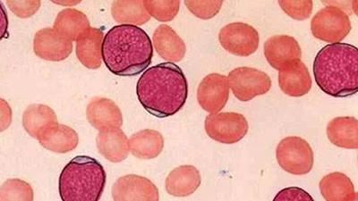 弱激光体外血液净化防止高血压患者年轻化,为