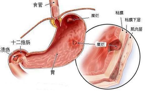 80后夫妻先后查出胃癌，当心两种饮食习惯让胃癌悄悄靠近!