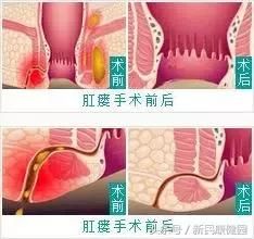 肛瘘,人生最痛苦的漏洞,VAAFT微创治疗安全