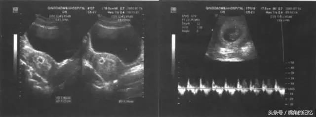 可收藏孕妈孕期医院医疗检查报告:早期妊娠超声