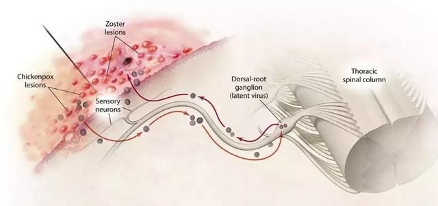 水痘痊愈就能终生免疫？其实病毒仍潜伏在神经