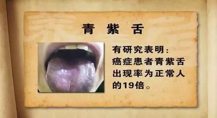 感冒还是上火?这样看舌头就能确定