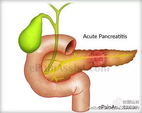 聊聊节日病:急性胰腺炎之为什么会得胰腺炎?