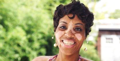 外休眠,内活跃的白斑是好转还是假象?_【快资