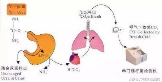 检测幽门螺杆菌,13 C尿素呼气试验和14C有什