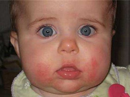 宝宝为什么脸上起了小红点 是过敏了吗