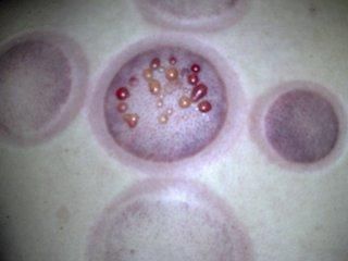 别以为拔火罐颜色黑紫就是湿气重,起水泡不一