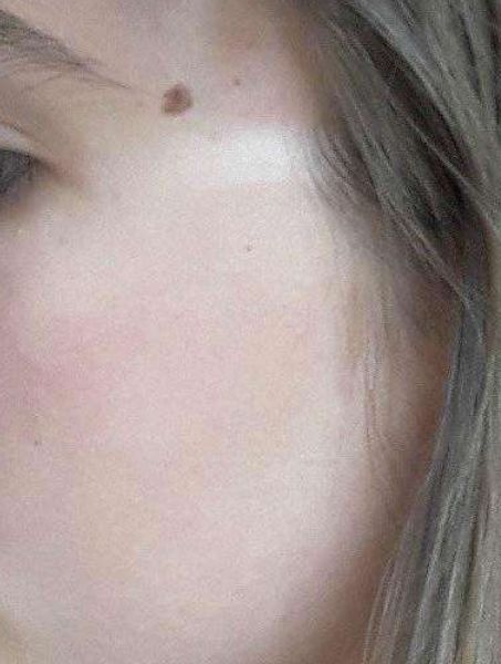 听说做完近视眼手术,老了会瞎?这是真的吗?