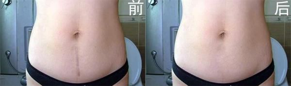 剖腹产费用多少