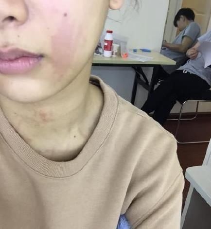 荨麻疹没完没了?一种中医良方,用一个好一个!