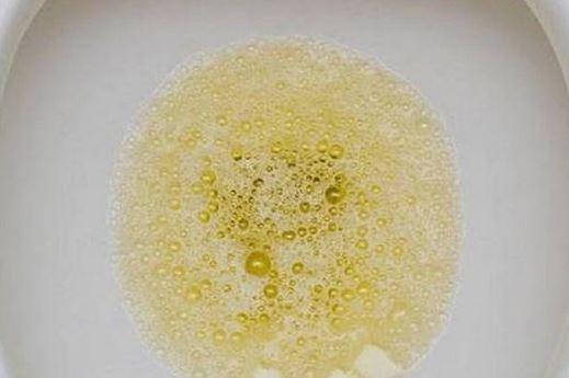 尿液有泡沫就意味着蛋白尿吗?这才是蛋白尿与