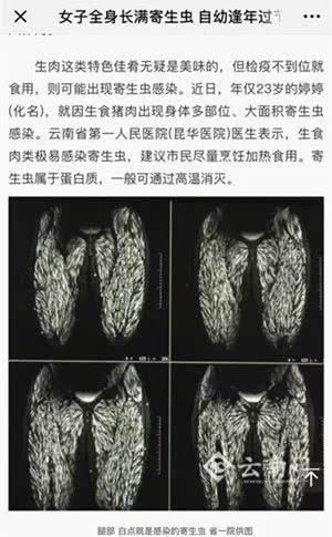 全身重复涌现疼痛,在医院检查后检查确认她患了"囊虫病,混身多处长满